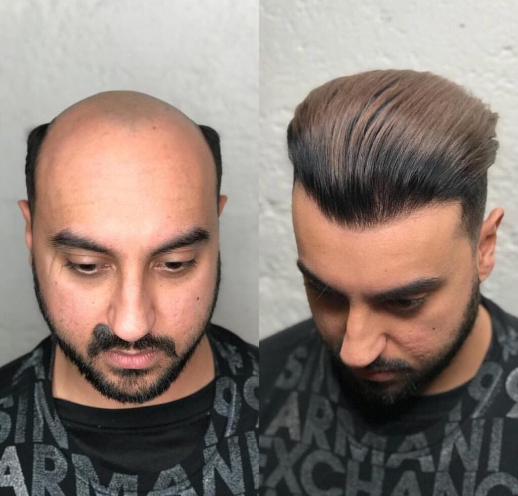 Trusted in hair replacement in bangalore since 1998 - the best Hair Patch Fixing Services