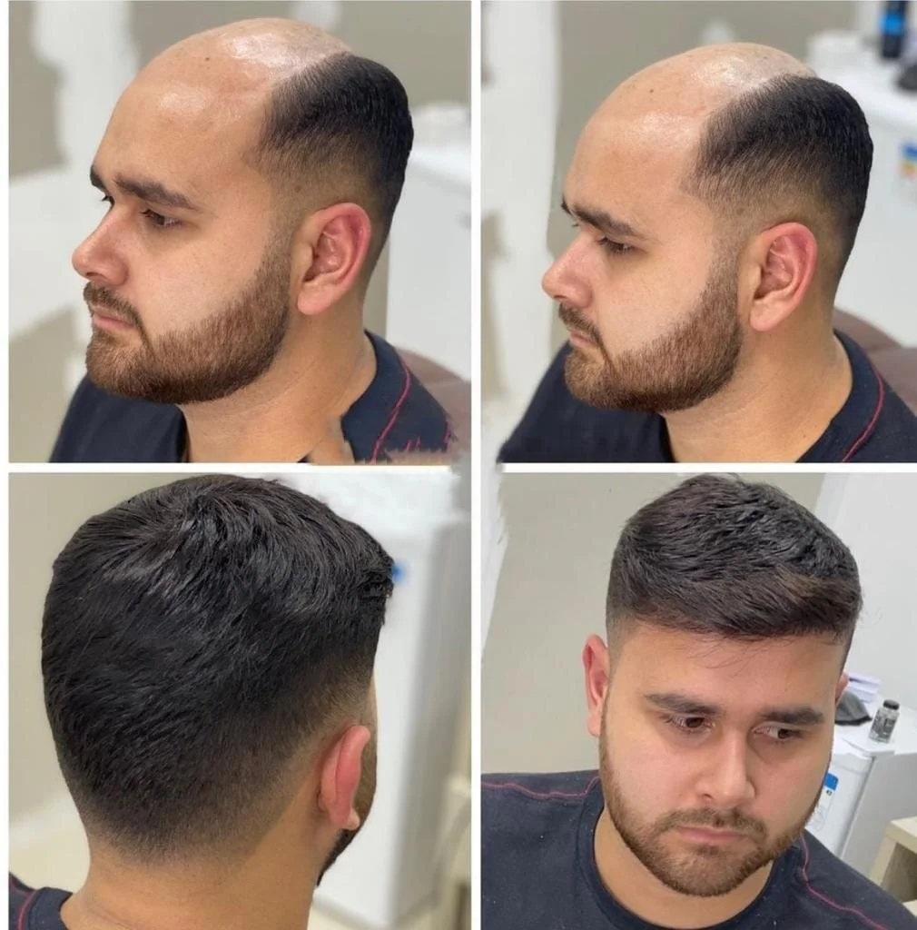 Actual cutomer images of hair patch fixing in bangalore and dubai