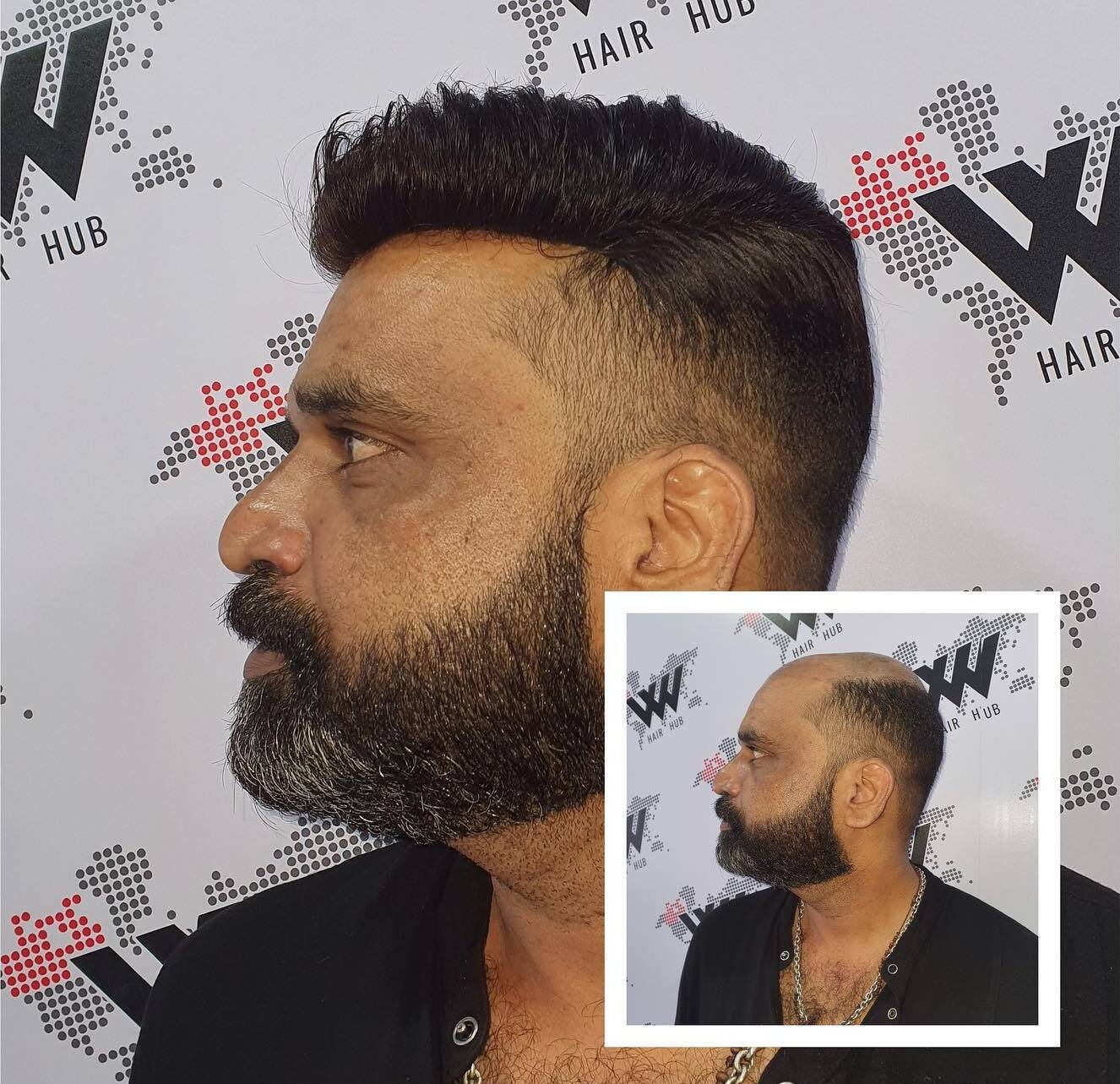 Know all about Hair patch and how it is suitable for everyone