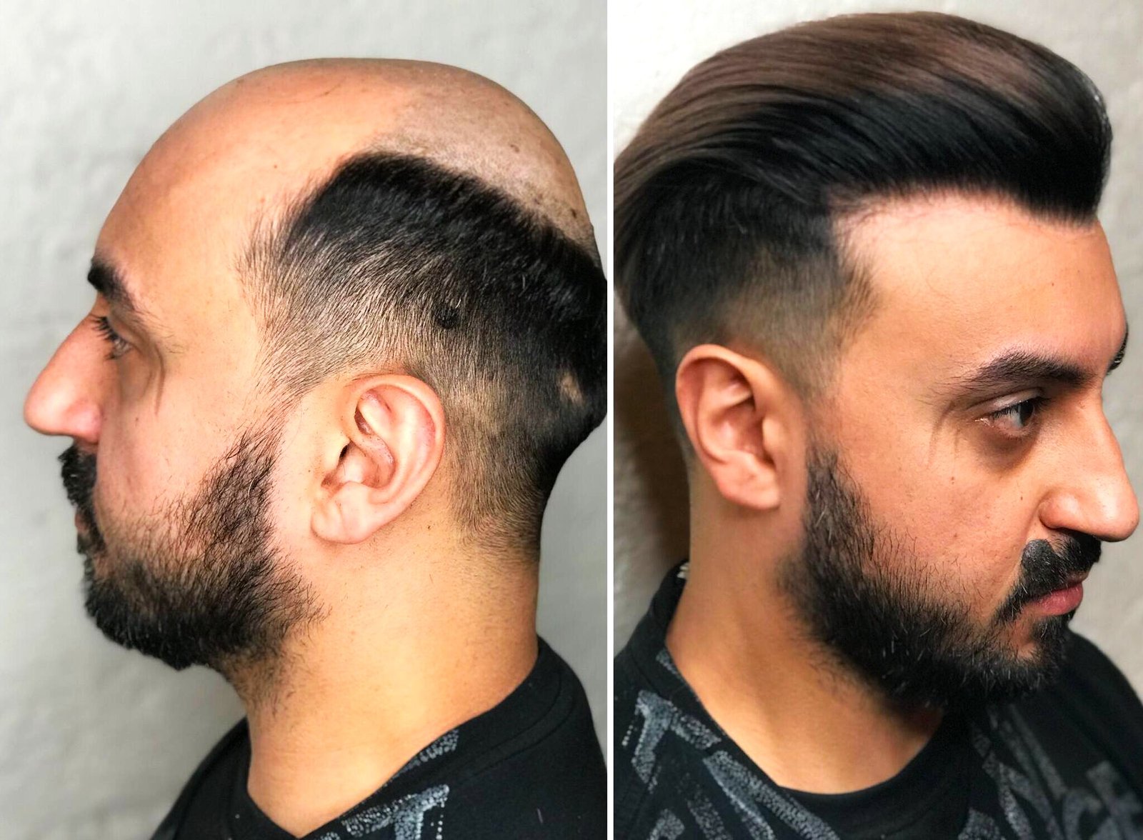 Non-Surgical Hair Fixing in Bangalore from World Wide Hair Hub