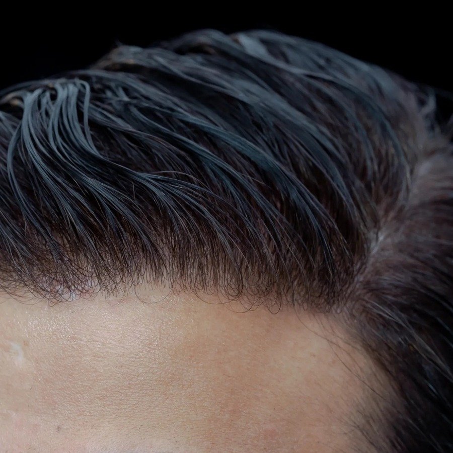 Hair Patch Fixing in Bangalore - services  available near Manyata Tech Park